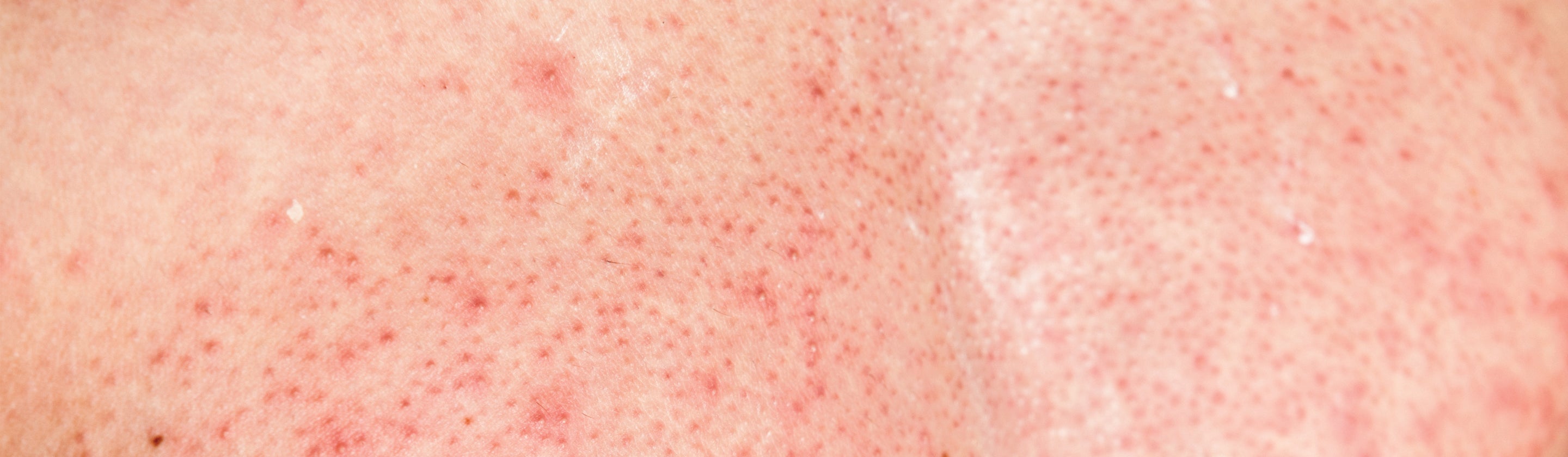 From Ouch to Oh Yeah: How to Eliminate Post-Waxing Irritation and Win Over Clients